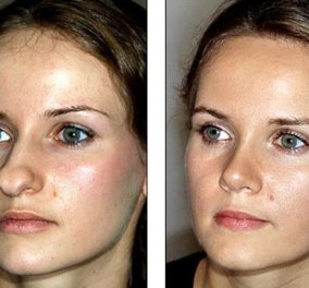 Η γυναίκα αυτή έκανε επιτυχημένη πλαστική στη μύτη της & έγινε κούκλα - δείτε το πριν & το μετά