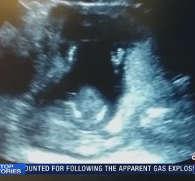 Το βίντεο της ημέρας που έγινε viral σε χρόνο ρεκόρ - Έμβρυο χτυπά παλαμάκια στην κοιλιά της μητέρας του! - Κυρίως Φωτογραφία - Gallery - Video