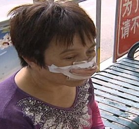 Story: Άνδρας δάγκωσε, έκοψε & κατάπιε τη μύτη της πρώην γυναίκας του γιατί αγνοούσε τις κλήσεις του - Κυρίως Φωτογραφία - Gallery - Video