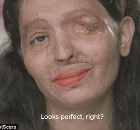 Της επιτέθηκε ο κουνιάδος της με οξύ & κατέστρεψε το όμορφο πρόσωπο - Εκείνη δεν το βάζει κάτω - Κυρίως Φωτογραφία - Gallery - Video