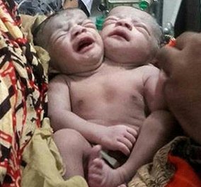 Ένα ή δύο μωρά; Βρέφος με δύο κεφάλια γεννήθηκε στο Μπαγκλαντές -(φώτο)  - Κυρίως Φωτογραφία - Gallery - Video
