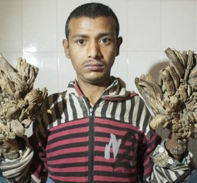 Η συγκινητική ιστορία του 25χρονου Abul: Μέρα με τη μέρα μετατρέπεται σε δέντρο λόγω σπάνιας πάθησης - Κυρίως Φωτογραφία - Gallery - Video