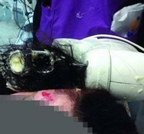Πάτρα: Το μίξερ που έφτιαχνε σκορδαλιά της έπιασε τα μαλλιά και κατέληξε στο νοσοκομείο - Κυρίως Φωτογραφία - Gallery - Video