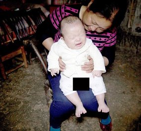 Γεννήθηκε μωράκι στην Κίνα με 31 δάχτυλα σε χέρια και πόδια (φωτό) - Η  σπάνια πάθηση που εμφανίζεται σε 1 ανά 1000 βρέφη