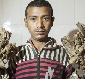 Για την 26η εγχείρηση στο νοσοκομείο ο 28χρονος άνθρωπος  - δέντρο  από το Μπαγκλαντές – Χειροτέρευσε η κατάστασή του - Κυρίως Φωτογραφία - Gallery - Video