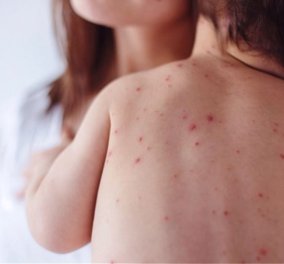 Σκληρό μέτρο για ανεμβολίαστα παιδιά – Το αντιεμβολιαστικό κίνημα & η μεγάλη επιδημία  - Κυρίως Φωτογραφία - Gallery - Video