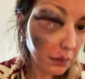 Σταυρούλα Τζαφέρη: «Δέχτηκα απειλές ότι θα μου κλείσουν και το άλλο μάτι» - τι είπε η food blogger που ξυλοκοπήθηκε (βίντεο)