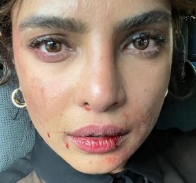 H Priyanka Chopra με μελανιες & αίματα στο πρόσωπο: «Είχε κάποιος άλλος μια δύσκολη μέρα στη δουλειά;» (φωτό) - Κυρίως Φωτογραφία - Gallery - Video