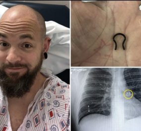 Story of the day: Άνδρας που έχασε το σκουλαρίκι στη μύτη πριν από 5 χρόνια το βρήκε κολλημένο στον πνεύμονά του