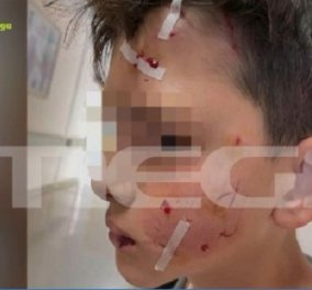 Λαγονήσι - η μητέρα του 14χρονου που δέχτηκε επίθεση από σκύλο: «Πήραν το παιδί αιμόφυρτο, θα τον είχε σκοτώσει» (βίντεο)