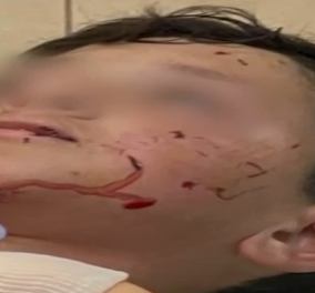 Λαγονήσι: Με σοβαρά τραύματα 13χρονος που δέχθηκε άγρια επίθεση από σκύλο φύλακα (βίντεο) - Κυρίως Φωτογραφία - Gallery - Video